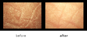 Appearance of skin surface